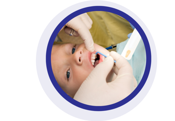 Fluoride Varnish